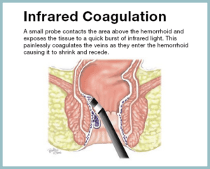non-surgical infrared coagulation treatment