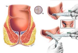 non-surgical hemorrhoid banding treatment