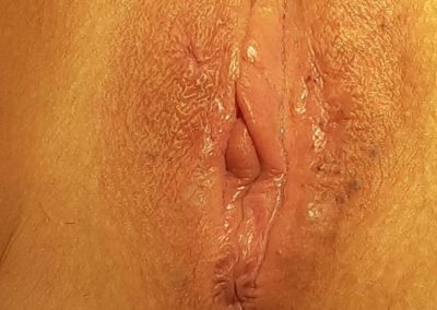 labrial repair