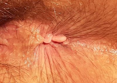After Hemorrhoid Removal