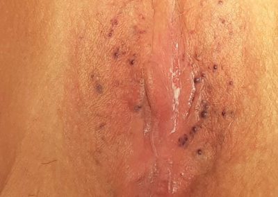 Before Labrial vericositis improvement