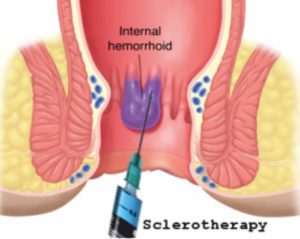 sclerotherapy hemorrhoid treatment