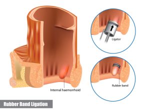 rubber band ligation - hemorrhoid banding